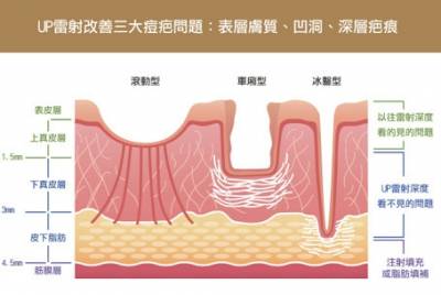 除疤特務．直擊痘疤孔