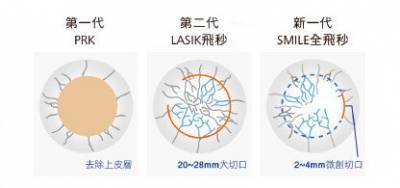 擺脫眼鏡的束縛 讓你擁有清晰好視力