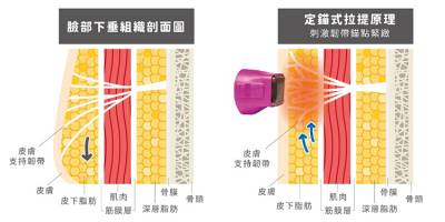 鳳凰電波「定錨式打法」 精準不痛免麻醉