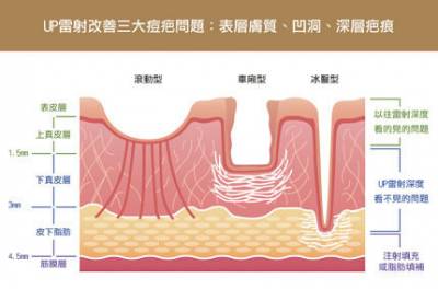 「UP雷射」告別難纏凹陷痘疤