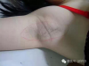 女生腋下「黑黑的」很難除？這招簡單有效.....原來我也不信的，一試就知效果！