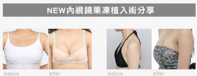 新式水滴形果凍矽膠隆乳