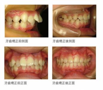 美牙強力趨勢 隱形矯正塑拉有形