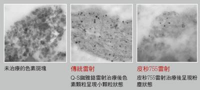 皮秒雷射正夯！為何有「 蜂巢」 的皮秒雷射就是有差？！